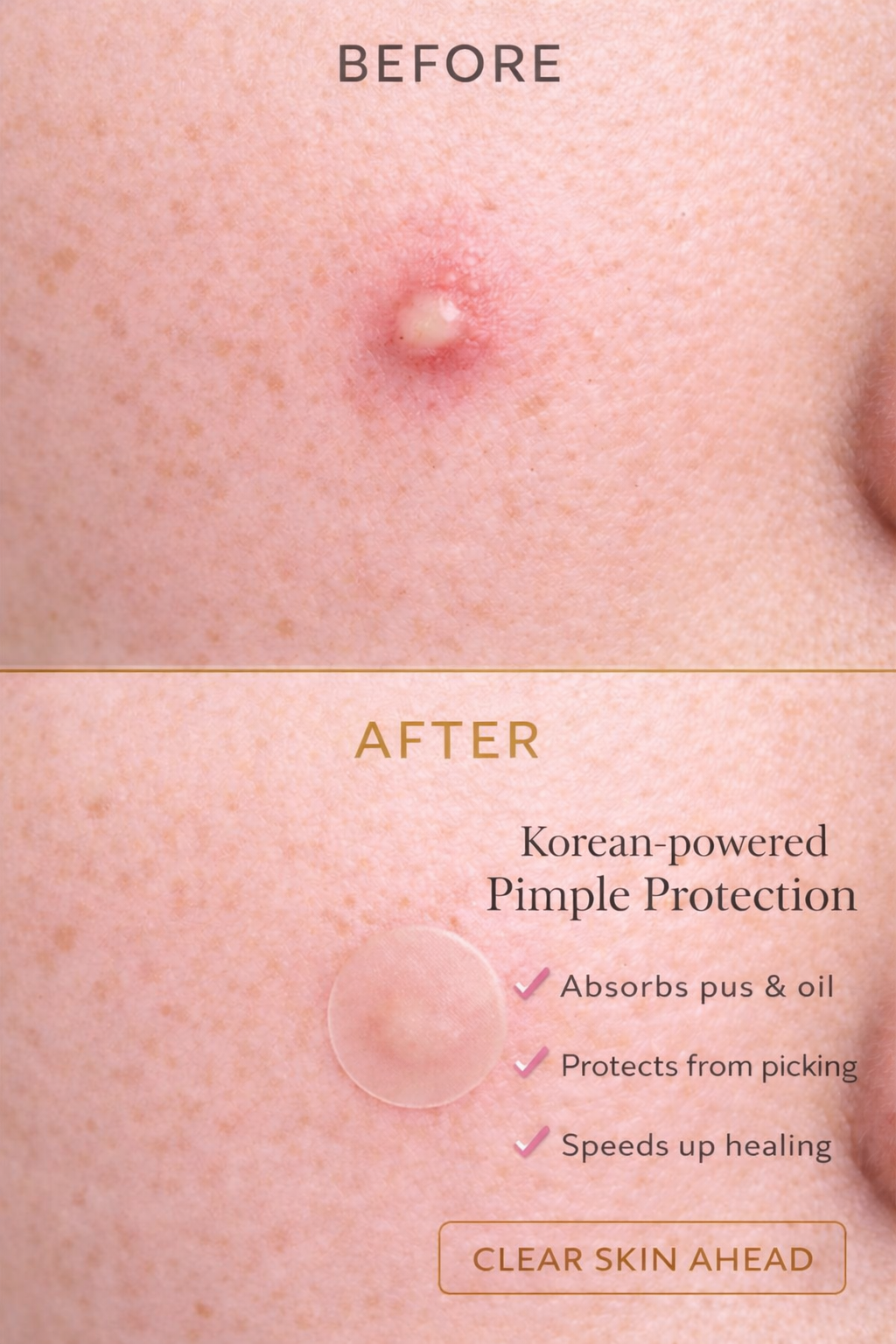 Super Infused Acne Stars